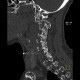 Osteolytic metastasis of cervical spine, fracture of dens axis, C2: CT - Computed tomography